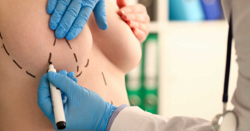 Implanty piersi doktor rysuje linie