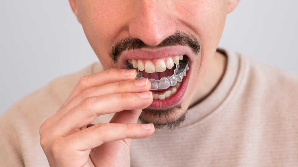 dorosły mężczyzna z wąsem aplikuje Invisalign na zęby