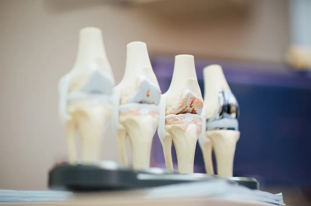 Przekrój anatomiczny zdrowego stawu kolanowego i stawu ze zmianami zwyrodnieniowymi